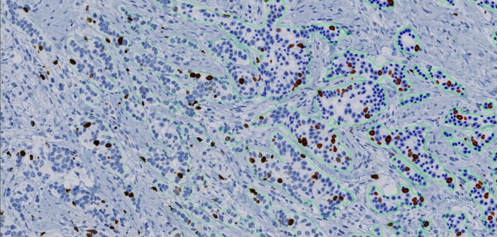 Ki-67 staining breast cancer cells.